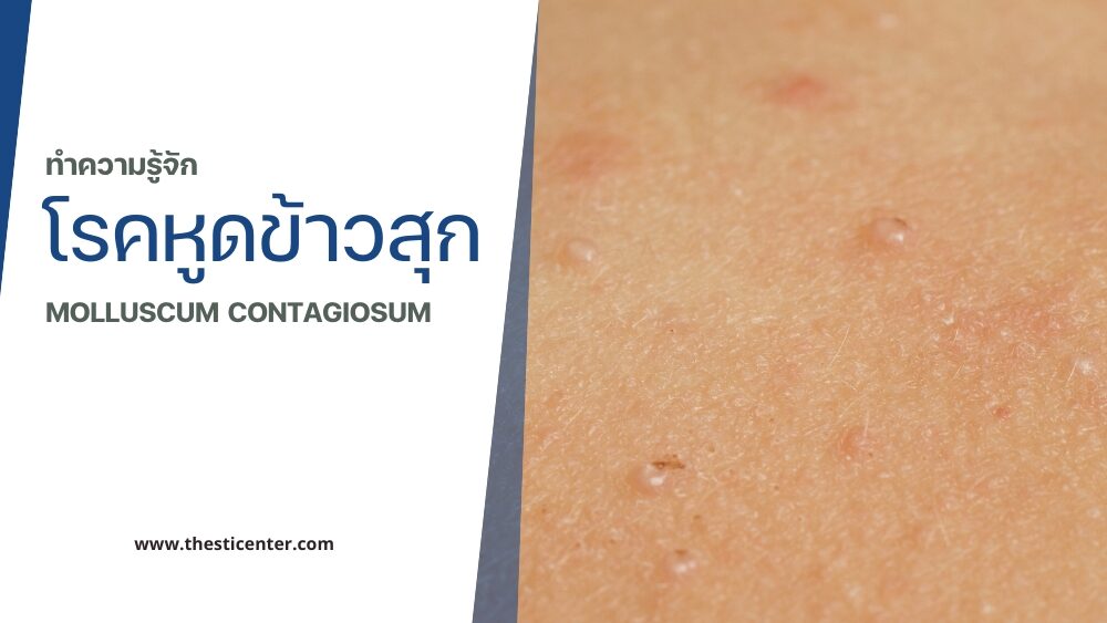 โรคหูดข้าวสุก (Molluscum Contagiosum)