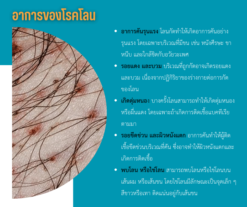 อาการของโรคโลน