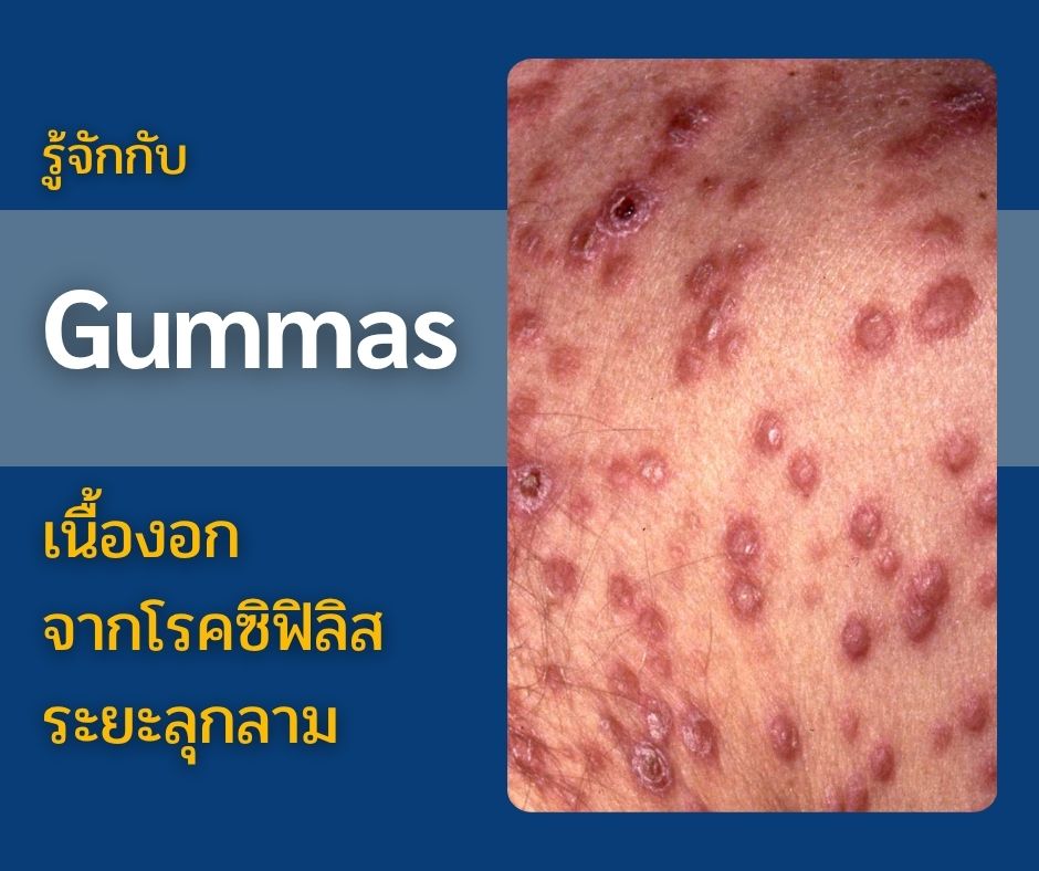 รู้จักกับ Gummas เนื้องอกจากโรคซิฟิลิสระยะลุกลาม