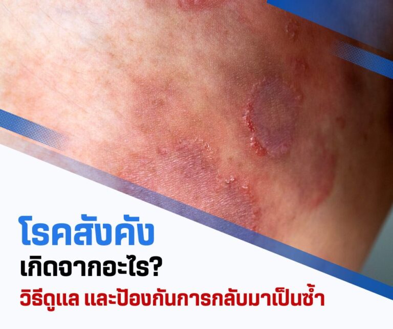 โรคสังคังเกิดจากอะไร? วิธีดูแลและป้องกันการกลับมาเป็นซ้ำ