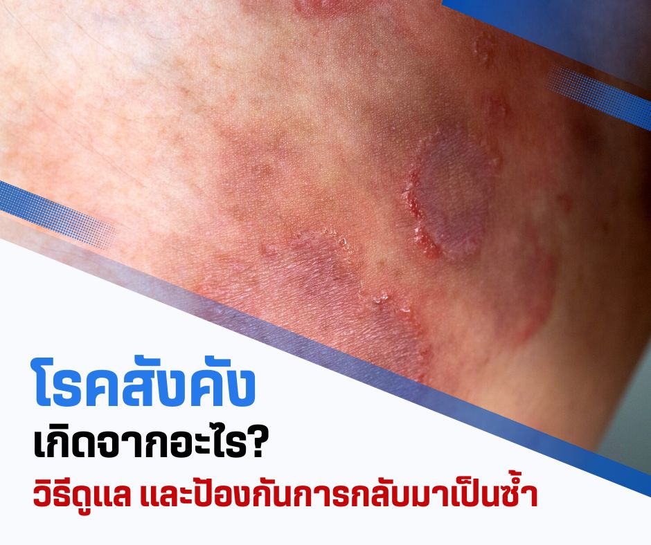 โรคสังคังเกิดจากอะไร? วิธีดูแลและป้องกันการกลับมาเป็นซ้ำ