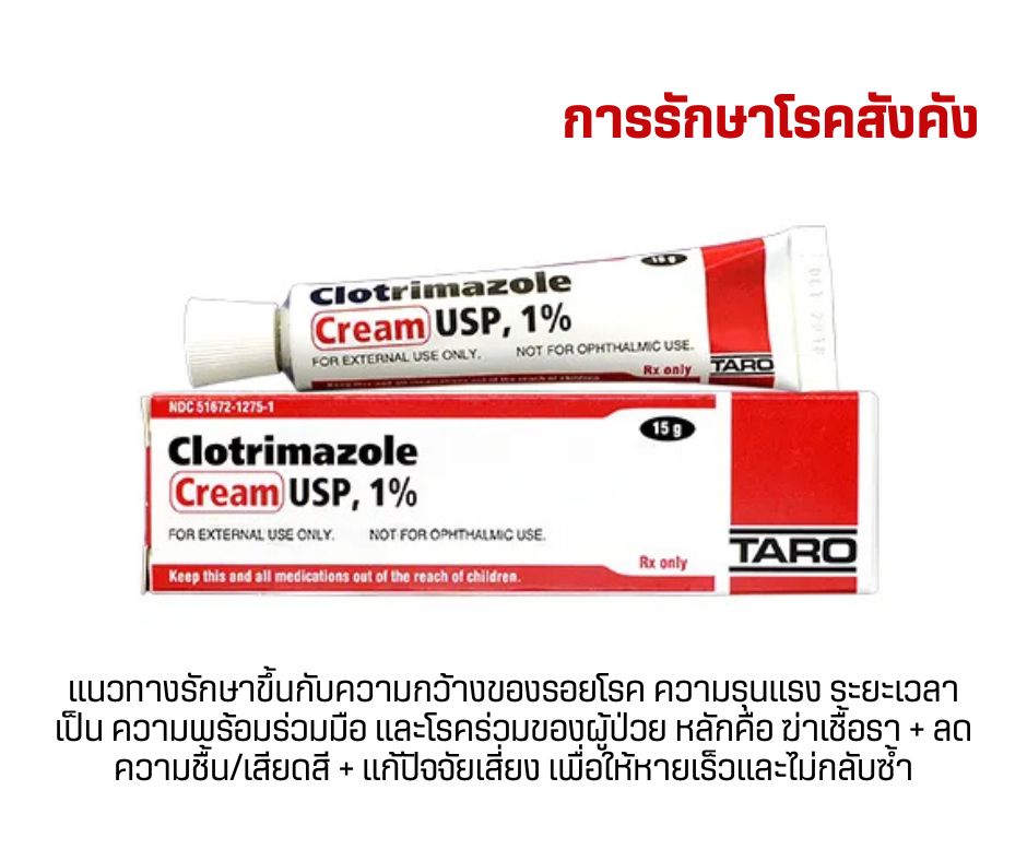 การรักษาโรคสังคัง