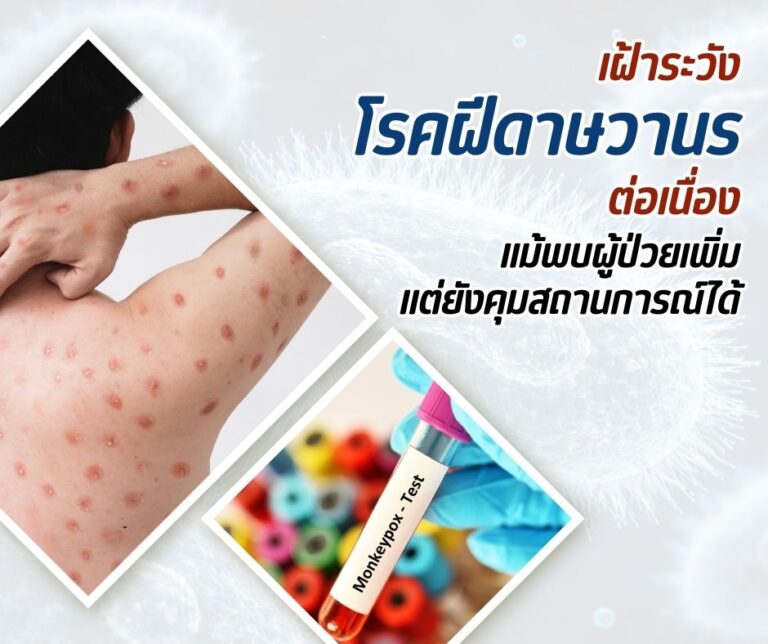 เฝ้าระวังโรคฝีดาษวานรต่อเนื่อง แม้พบผู้ป่วยเพิ่มแต่ยังคุมสถานการณ์ได้