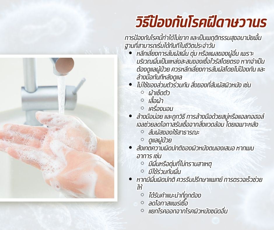 วิธีป้องกันโรคฝีดาษวานร